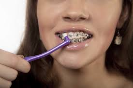 They should take the time to ensure that all plaque and debris is removed, and that they work all the way around upper and lower teeth. How To Brush Your Teeth With Braces Electric Teeth