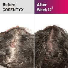 Many people see a dermatologist for treatment. Plaque Psoriasis Treatment Results Cosentyx Secukinumab