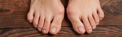 Image result for Hallux Varus