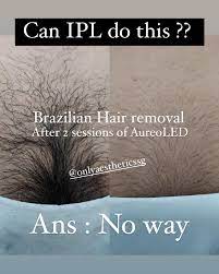 Only aesthetics is the aesthetic & laser clinic of choice in singapore that. Only Aesthetics There Was A Recent Poll Regarding Women And Body Hair 98 Preference Is To Be Totally Hair Free However With So Many Options Out There Which Is