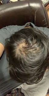 Going off your second picture, i don't think thats the start of thinning, i think you have a hair whorl like most people, and you've seen it under harsh lighting for the first time. Crown Thinning Or Just How My Hair Parts I Have Fine Hair And Have Two Hair Sworls Hairloss