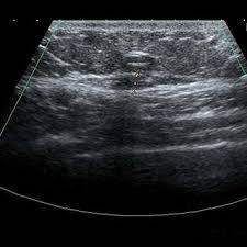 Mondor's disease is the chronic inflammation (thrombophlebitis) of superficial veins of thoracoabdominal or thoraco epigastric region. Pdf Bilateral Mondor S Disease In Chikungunya Virus Infection