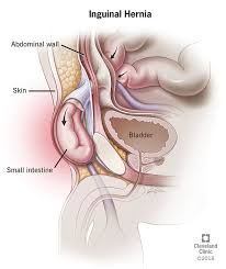 Image result for Inguinal hernia man