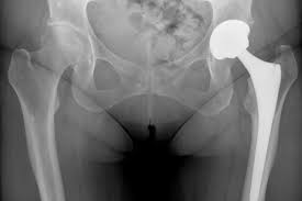 Am aflat recent ca la operatia complicata realizata de doctorul tona jorgaq a folosit protezele de la ronda medical. Proteza TotalÄ De Sold Sk S