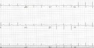 An 18 Year Old Female With Sudden Sharp Chest Pain Journal Of Urgent Care Medicine