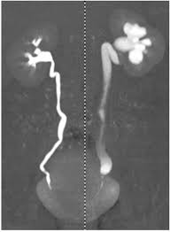 Politano leadbetter steps 1) incision through dome of bladder 00:12 2) identify location of politano leadbetter preimplantation, an intravesical supra trigonal technique avoids crossing of ureteric. Minimmally Invasive Resolution Of A Left Ureteral Stenosis After Schistosoma Haematobium Infection Sciencedirect