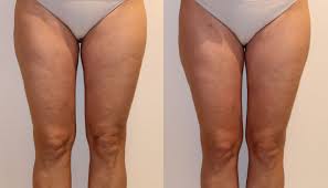 Check spelling or type a new query. Lymphatic Drainage Massage For Cellulite Reduction Beauty Studio Dana