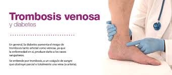 Deep venous thrombosis (dvt) is a manifestation of venous thromboembolism (vte). Diabetes Com Gt