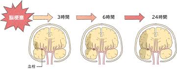 拥塞, 阻塞, 闭塞, 蔽塞 相关: è³å'ä¸­ã®çç¶ã¯ å¤§å¡è£½è¬