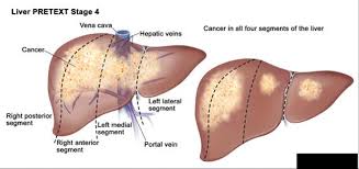 Liver cancer happens when liver cells develop changes (mutations) in their dna. Liver Tumors In Infancy Intechopen
