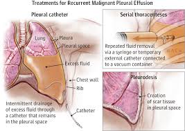 Malignant Pleural Effusions Pleural Effusion Medical Therapy Pulmonology