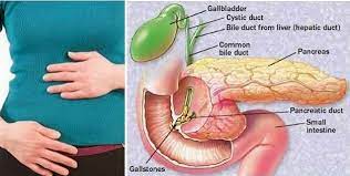 Penyebab utama dari sakit pinggang adalah karena otot atau ligament terkilir sehingga meregang secara berlebihan. Penawar Mujarab Jus Herbaneka Plus Rawat Sakit Buah Pinggang
