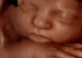 3D ultrasound images