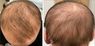 Hello, thanks for posting your query. Eczema Drug Could Be Cure For Hair Loss Restoring Growth In Months