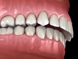 Image result for Occlusal