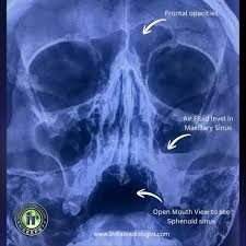 Image result for Sinus X Ray