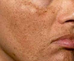4 Recetas Caseras Para Las Manchas En La Cara Manchas En La Cara Manchas Manchas Del Sol
