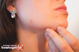 Sink er antibakteriell s ja den kan hjelpe mot kviser. Kviser Pa Haken Hos Kvinner Arsaker Og Behandling