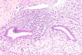 Increased abdominal size or persistent abdominal bloating abdominal or pelvic (lower tummy) pain Endometriosis Symptoms Diagnosis And Management The Pharmaceutical Journal