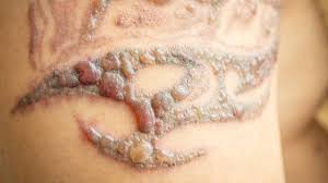 Find best laser resurfacing for scars & laser treatment for tattoo removal in ca for men & women. Can Laser Tattoo Removal Cause Blistering Medermis Laser Clinic