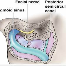 The sigmoid sinus is a continuation of the transverse sinus and becomes the sigmoid sinus where the tentorium cerebelli ends (figs. Schematic Drawing Illustrating The Important Anatomy Of Trautmann S Download Scientific Diagram