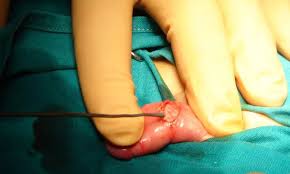 Image result for Phimosis