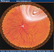 Retinal tears can best be treated with laser photocoagulation treatment in the office to fuse the retina to the back wall of. Management Of Primary Rhegmatogenous Retinal Detachment