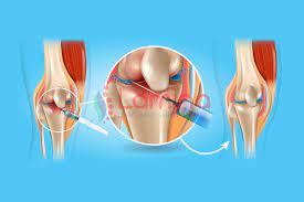 Salah satu diantaranya adalah pengapuran tulang sendi lutut. Lutut Bengkak Dan Terasa Kaku Atasi Dengan Terapi Injeksi Klinik Patella