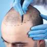 hair transplant in islamabad from www.glamorousclinic.com.pk
