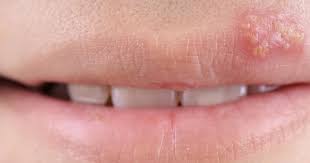 Es ist meist für genitalherpes (herpes genitalis) verantwortlich und wird hauptsächlich durch geschlechtsverkehr übertragen. Lippenherpes Focus Arztsuche
