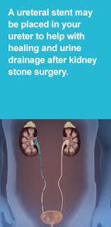 Pin On Kidney Stones