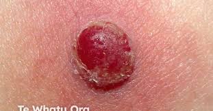 Image result for Pyogenic Granuloma