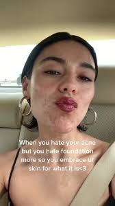 My page is becoming an acne acceptance page and im alright with it