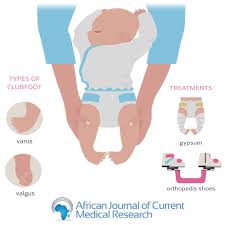 It's not painful for babies, but it can become painful and make it club foot is usually diagnosed after a baby is born, although it may be spotted during the routine. Clubfoot Archives African Journal Of Current Medical Research