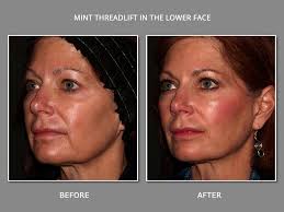 Notice the big improvement in the jowl and the lower face. Mint Thread Lift Instant Non Surgical Facelift With Threads