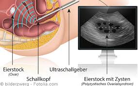 With pcos, your body may have high amounts of. Polyzystisches Ovarialsyndrom Pcos Symptome Diagnostik Therapie Gelbe Liste