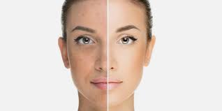 Jan 05, 2018 · bei pigmentflecken ist die die bildung der farbpigmente (dem melanin) in der haut gestört, es kommt zu farbveränderung. wenn wir im alltag von pigmentflecken sprechen, meinen wir dabei in den meisten fällen bräunliche, ungleichmäßige hautveränderungen im gesicht oder an den händen. Punktsieg Gegen Pigmentflecken So Klappt Es Wirklich