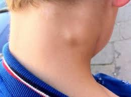 Uvelicheny Limfouzly Na Shee U Rebenka Prichiny Simptomy I Lechenie Gorodskaya Klinicheskaya Bolnica 1