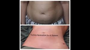Liposuction In Lahore Pakistan By Dr Saleem Plastic Surgeon 2018 Liposuction Plastic Surgeon Liposuction Cost