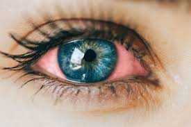 Decolarea de retina separa celulele retinei de stratul vaselor de sange care alimenteaza acea zona cu oxigen. Simptomul De Ochi Rosu Cauze Si Tratament Catena