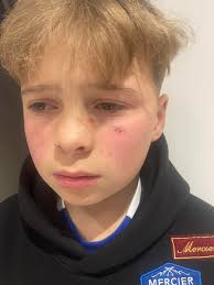 Imagine standing outside KFC with your friends minding your own business  and a gang of 15 kids walking up and then decide three of them punch you in  the face repeatedly 🥹