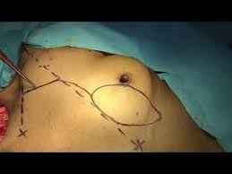 We did not find results for: Marking And Planning For Pectoralis Major Myo Cutaneous Flap Youtube
