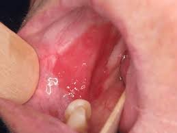 Image result for Erythroplakia roof of mouth