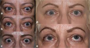 Case 3: Preoperative aspect of a Graves' ophthalmopathy patient in...