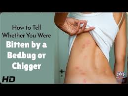 Image result for bedbugs bites
