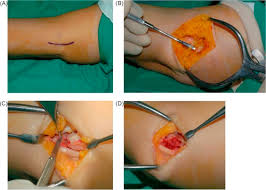 It is sometimes called tennis elbow, although it can occur with many activities. The Result Of Surgical Treatment Of Medial Epicondylitis Analysis With More Than A 5 Year Follow Up Journal Of Shoulder And Elbow Surgery