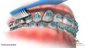 Brushing your teeth is a habit you've had ingrained since early childhood, so it's fitting that people sometimes compare other good routines to dental hygiene. Life With Braces Brushing Flossing Youtube