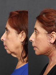 Only 1 day after surgery. This is NOT a full face lift. We performed a Lowe  facelift, deep plane neck lift and chin augmentation yesterday. Patient did  not desire any changes on