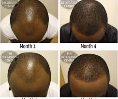 It will help you gain more volume to your hair. 4 Foods That Help In Hair Loss Youth Village Kenya