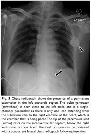 Pin On Cardiac Pacing